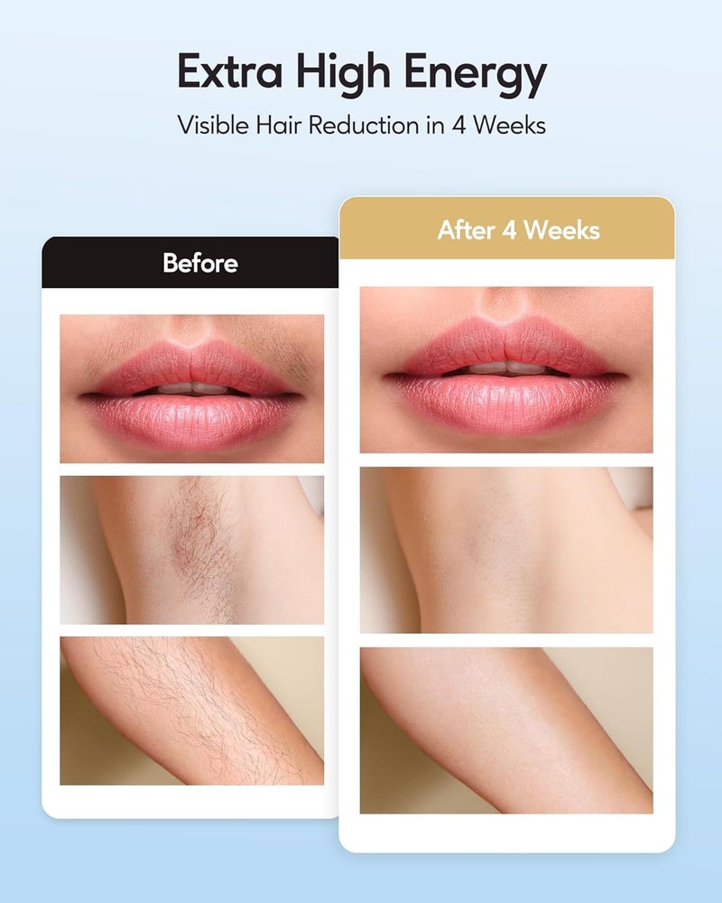 innza IPL Hair Removal with Ice Cooling Care Function for Women,Long-Lasting Results,999,999 Flashes Painless IPL Hair Remover, Hair Removal Device for Armpits Legs Arms Bikini Line - Image 4